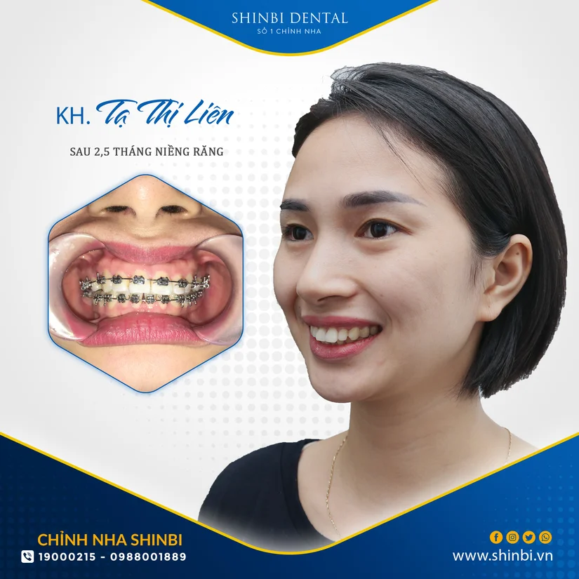 Răng hô khiến môi không khép kín nên chỉnh nha ở đâu tại Hà Nội