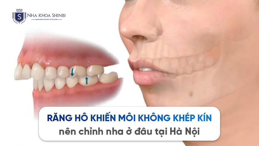 Răng hô khiến môi không khép kín nên chỉnh nha ở đâu tại Hà Nội
