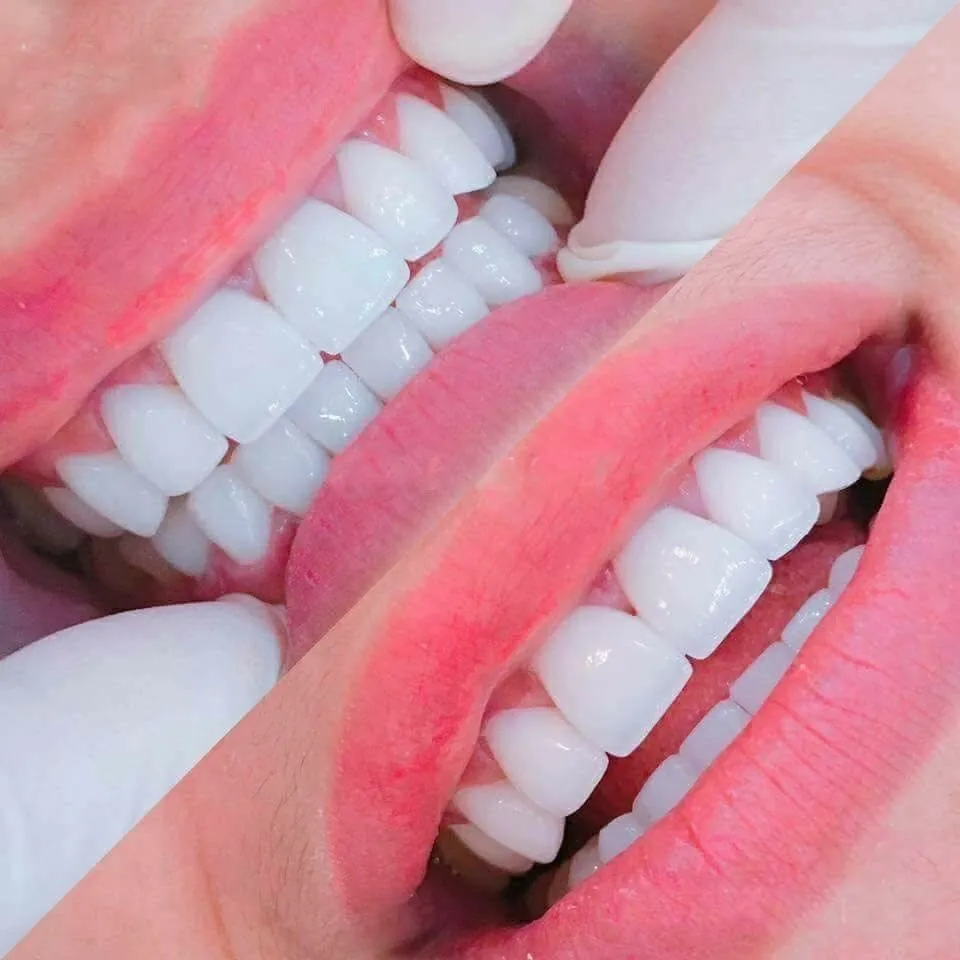 Răng sứ thẩm mỹ là gì? Ưu nhược điểm & đối tượng phù hợp