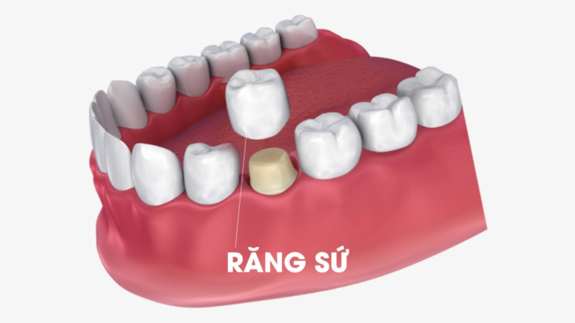 Răng sứ thẩm mỹ là gì? Ưu nhược điểm & đối tượng phù hợp