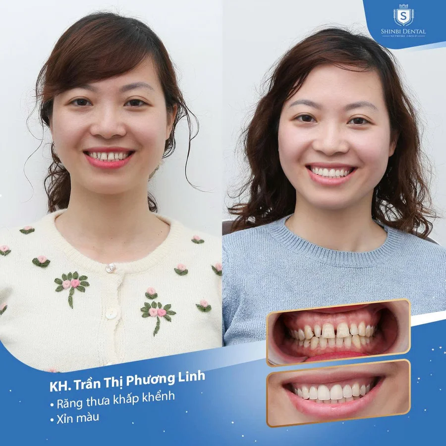 Răng sứ thẩm mỹ là gì? Ưu nhược điểm & đối tượng phù hợp