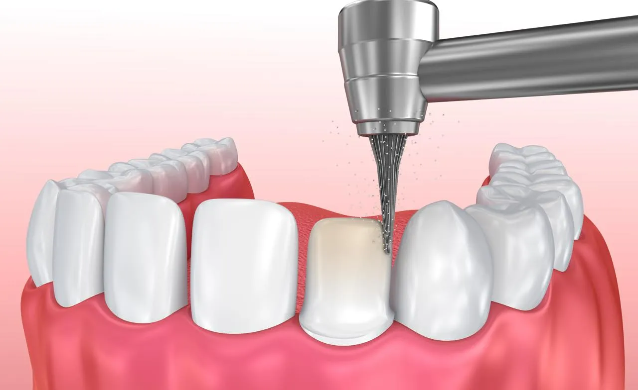 Răng sứ thẩm mỹ là gì? Ưu nhược điểm & đối tượng phù hợp
