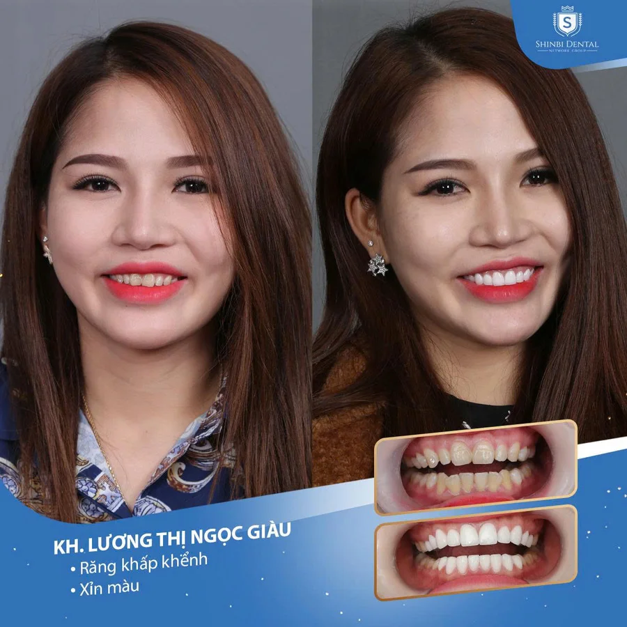 Răng sứ thẩm mỹ là gì? Ưu nhược điểm & đối tượng phù hợp