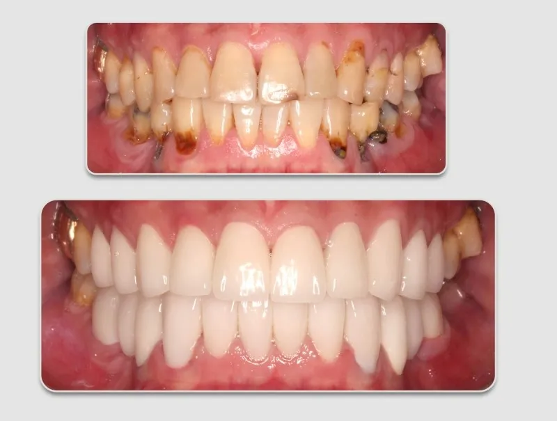 Răng sứ thẩm mỹ là gì? Ưu nhược điểm & đối tượng phù hợp