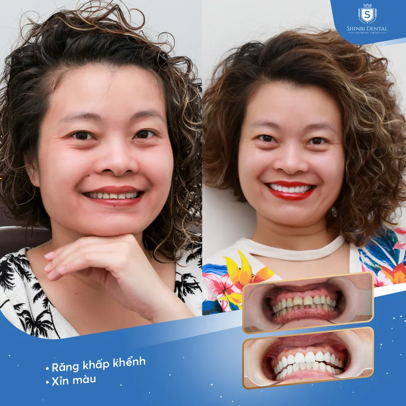 Răng sứ Venus giá bao nhiêu