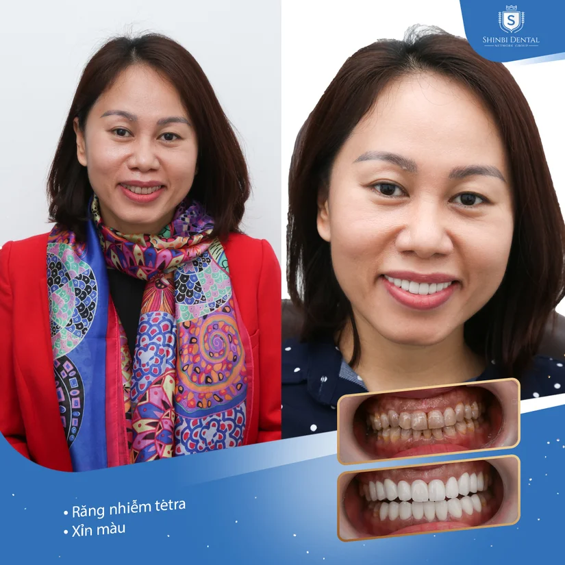 Răng sứ Venus giá bao nhiêu