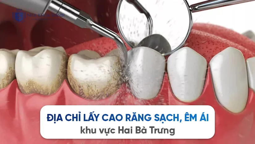 Shinbi Dental – Địa chỉ lấy cao răng sạch, êm ái khu vực Hai Bà Trưng