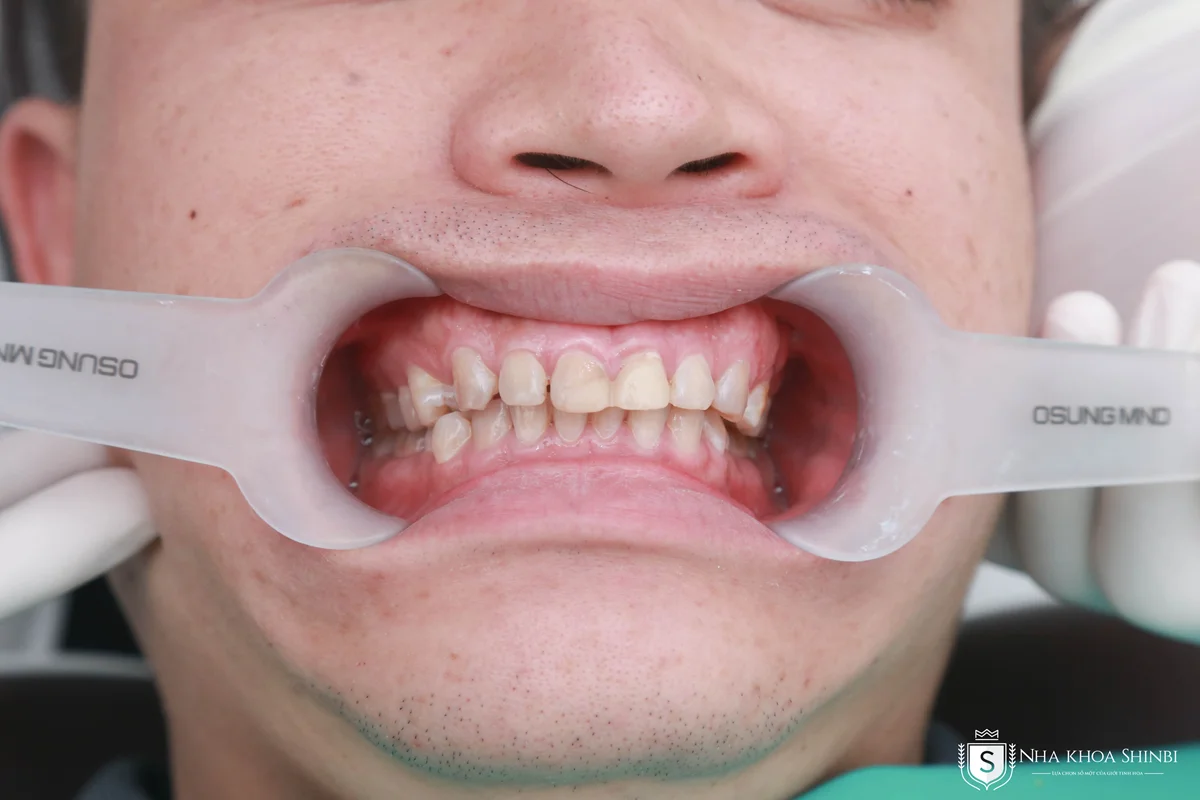 So sánh Niềng răng và Bọc sứ: chọn giải pháp nào tốt hơn