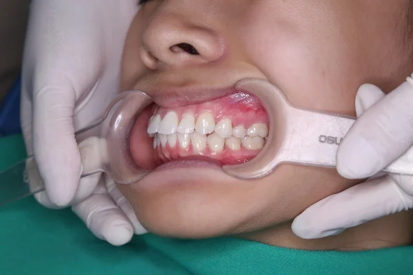 So sánh Niềng răng và Bọc sứ: chọn giải pháp nào tốt hơn