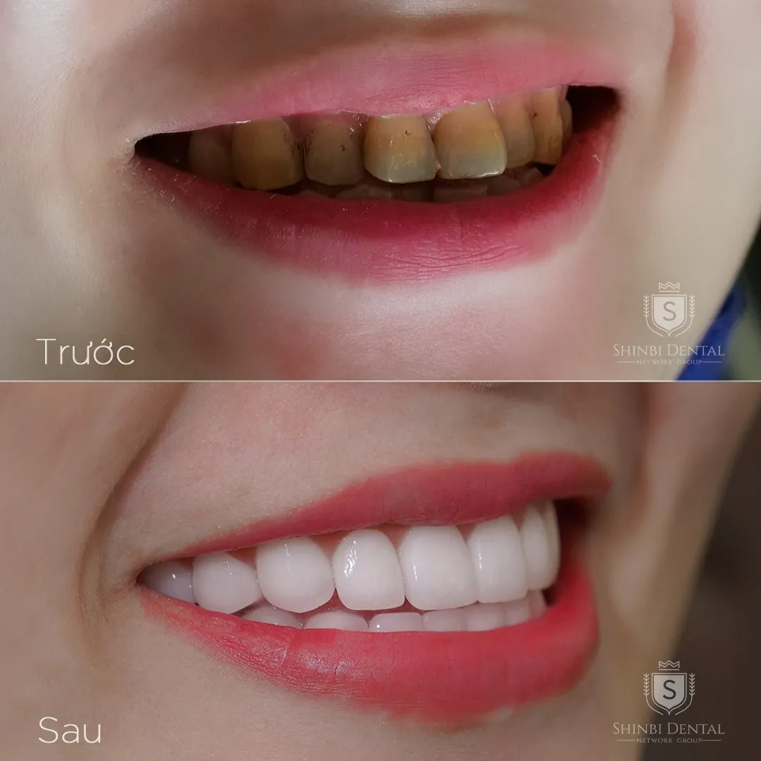 Vì sao cuối năm nhiều người chọn làm răng sứ