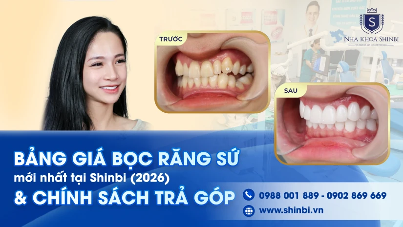 Bảng giá bọc răng sứ mới nhất tại Shinbi (2026) & Chính sách trả góp