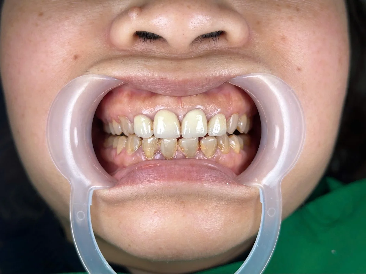 Địa chỉ bọc răng sứ Orodent chính hãng tại Trần Quốc Toản