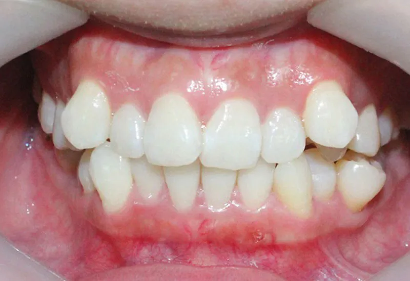 Chỉnh nha trả góp tại Hải Phòng: Duyệt hồ sơ nhanh 15 phút