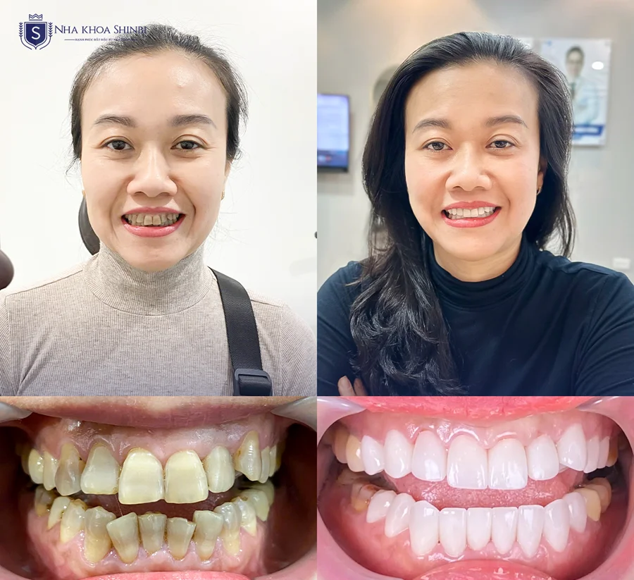 Dịch vụ dán sứ Veneer đẹp tự nhiên tại Shinbi Dental số 33 Trần Quốc Toản