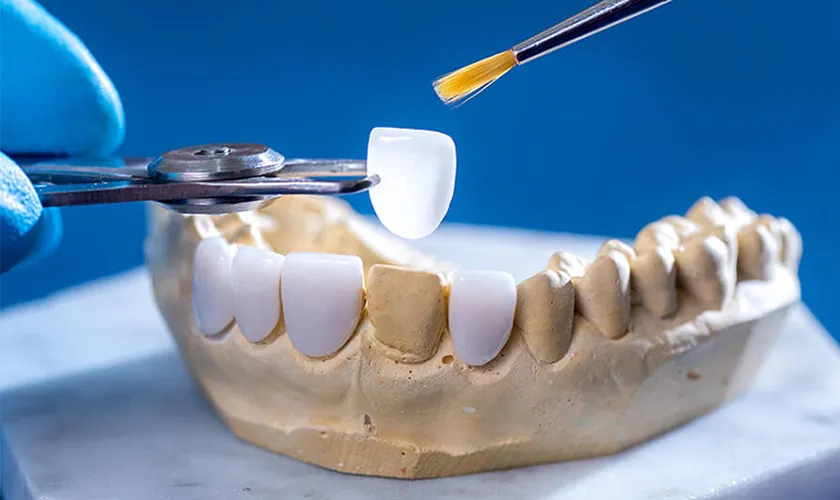 Dịch vụ dán sứ Veneer đẹp tự nhiên tại Shinbi Dental số 33 Trần Quốc Toản