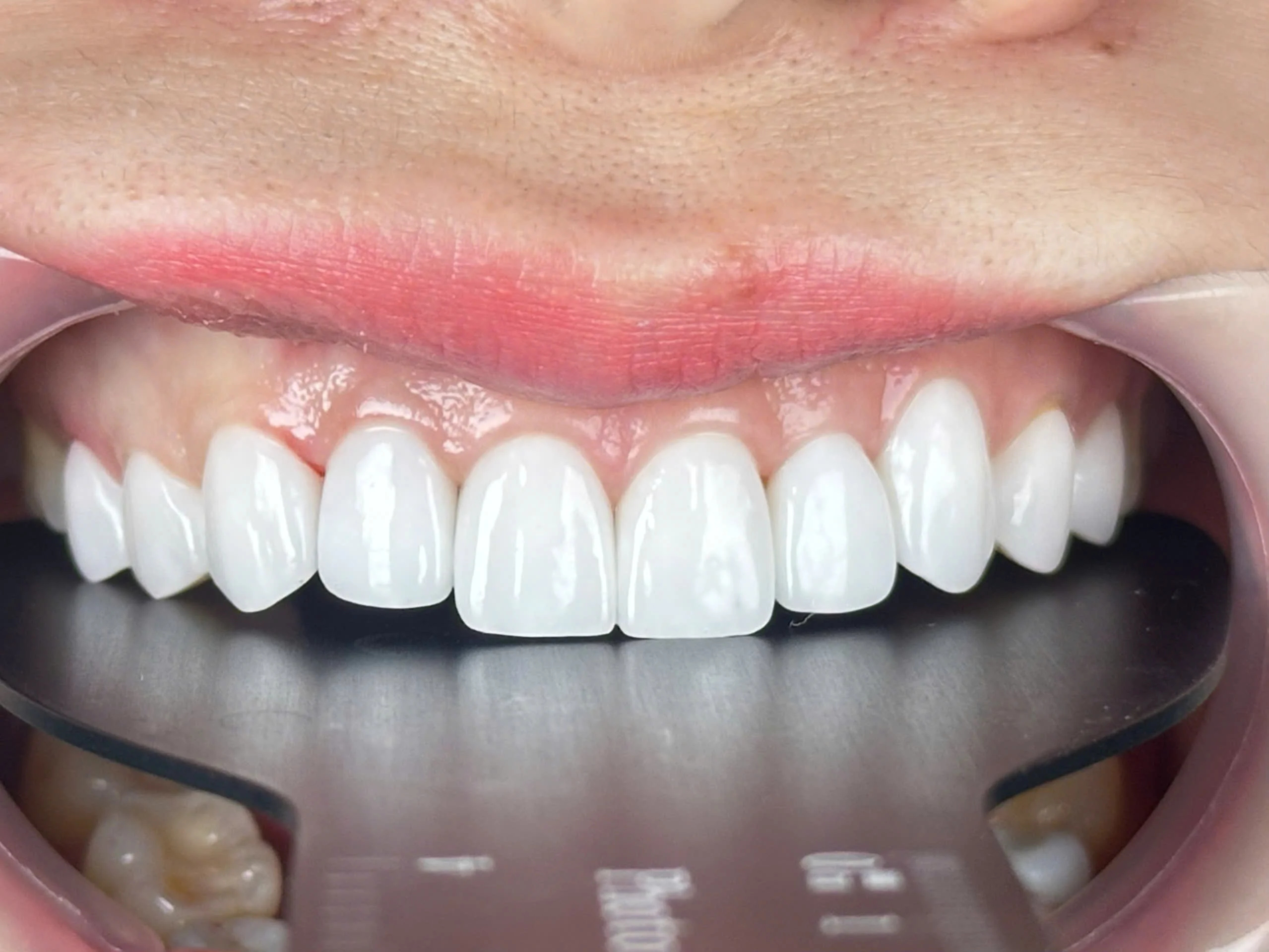 Dịch vụ dán sứ Veneer đẹp tự nhiên tại Shinbi Dental số 33 Trần Quốc Toản