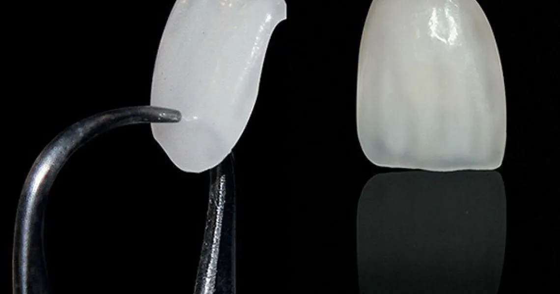 Dịch vụ dán sứ Veneer đẹp tự nhiên tại Shinbi Dental số 33 Trần Quốc Toản