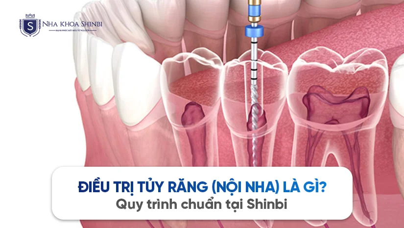 Điều trị tủy răng (Nội nha) là gì? Quy trình chuẩn tại Shinbi