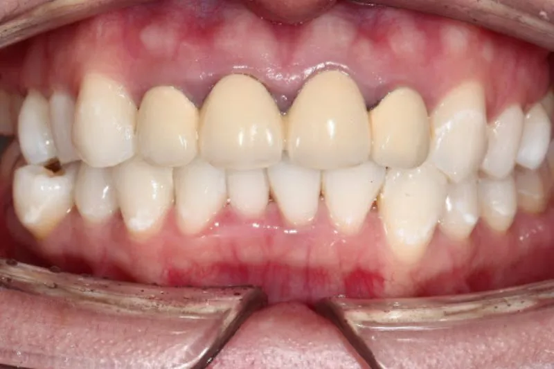 Nên chọn răng sứ nào để không bị đen viền nướu?
