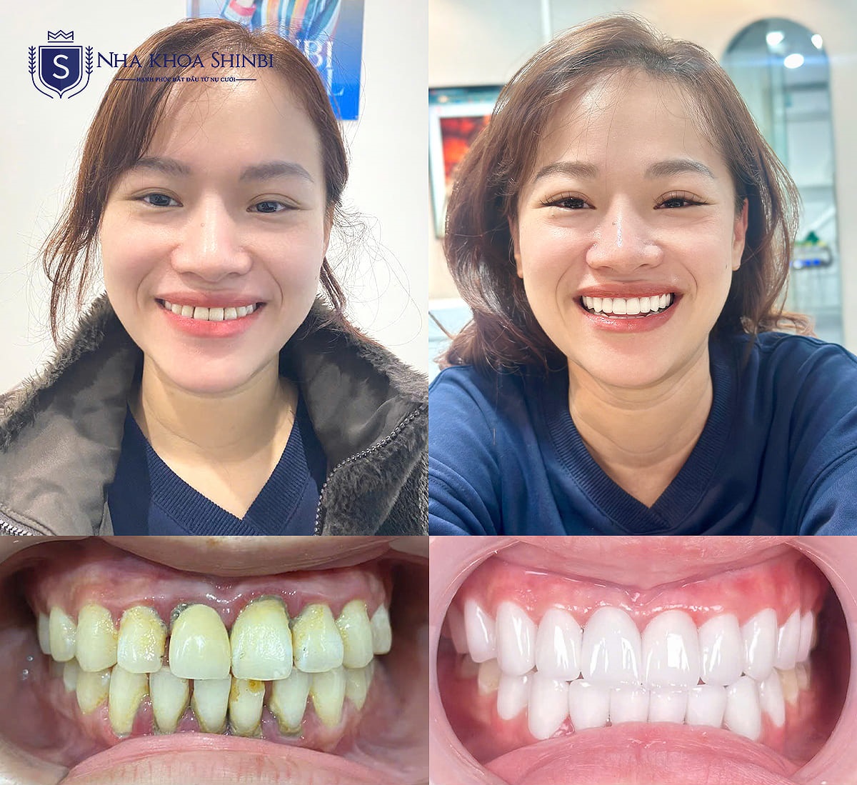 Nên chọn răng sứ nào để không bị đen viền nướu?