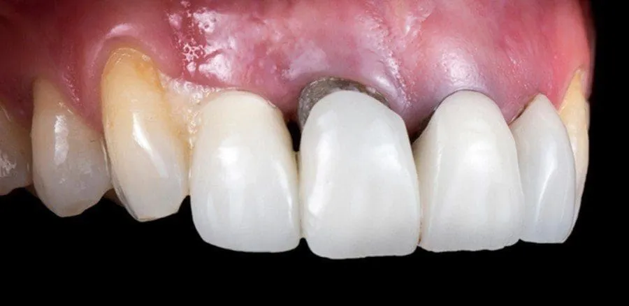 Nên chọn răng sứ nào để không bị đen viền nướu?