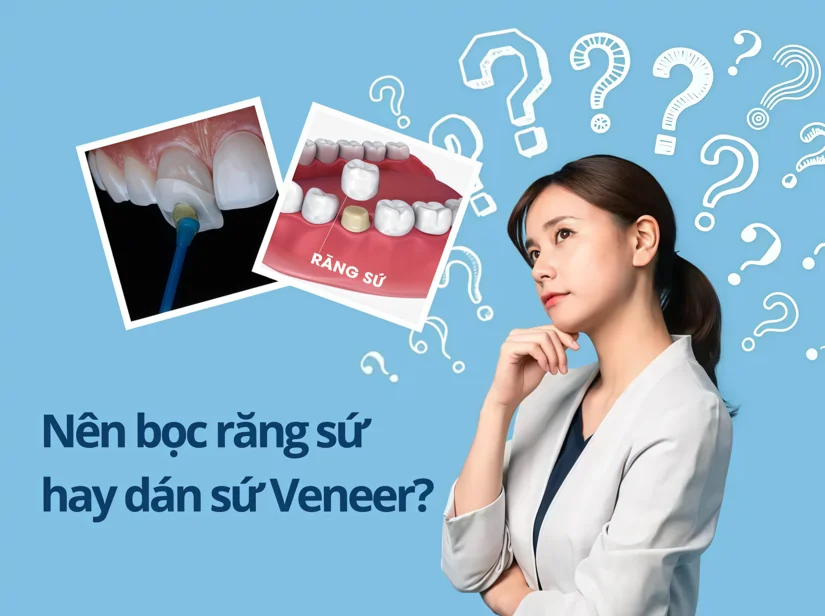 Nên dán sứ Veneer hay bọc sứ toàn phần để kịp ăn Tết?