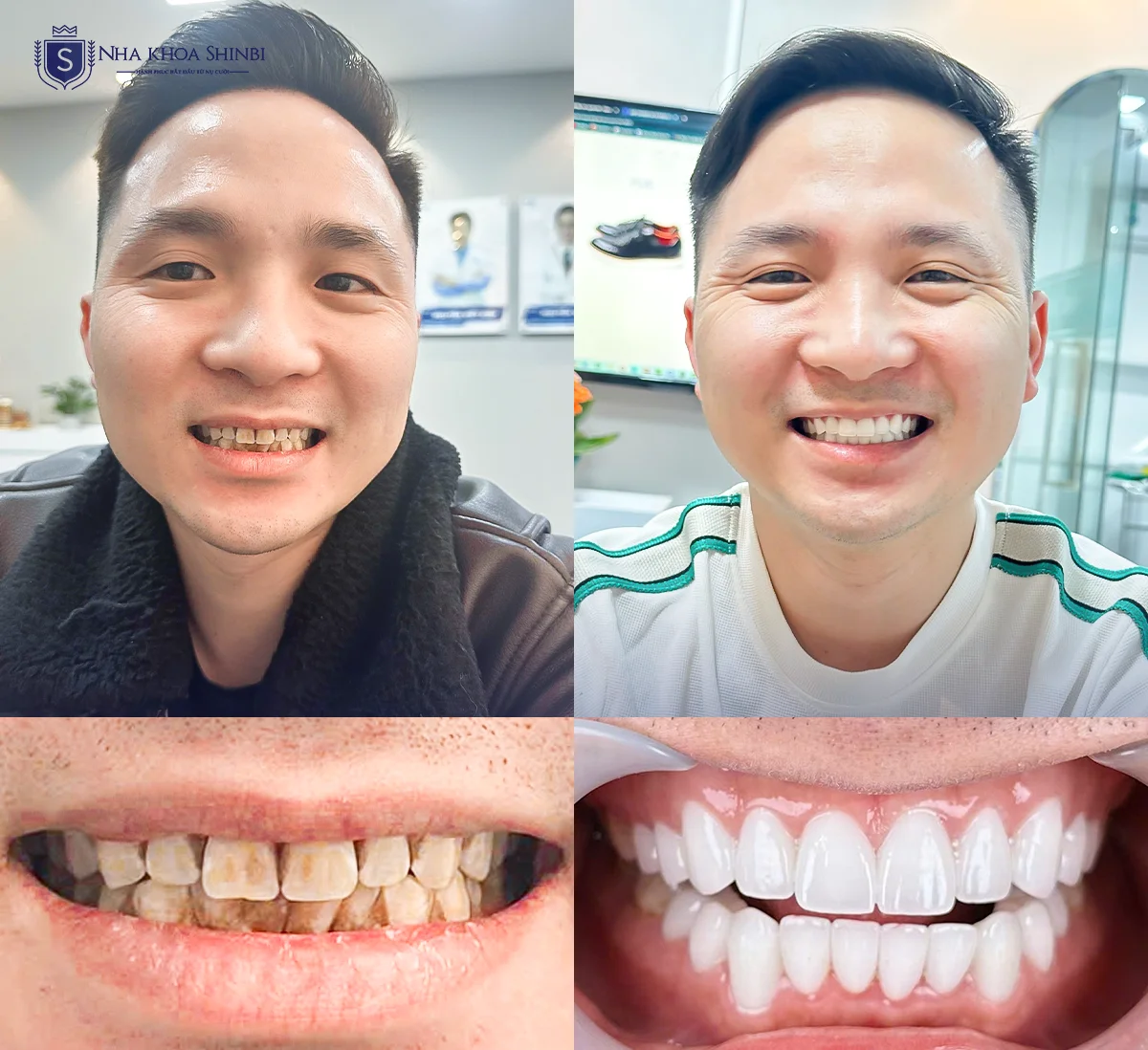 Nên dán sứ Veneer hay bọc sứ toàn phần để kịp ăn Tết?