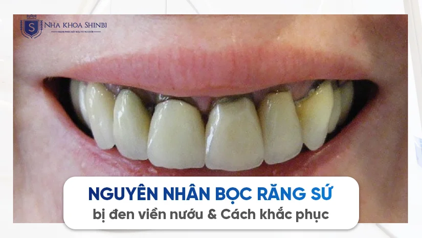 Nguyên nhân bọc răng sứ bị đen viền nướu & Cách khắc phục