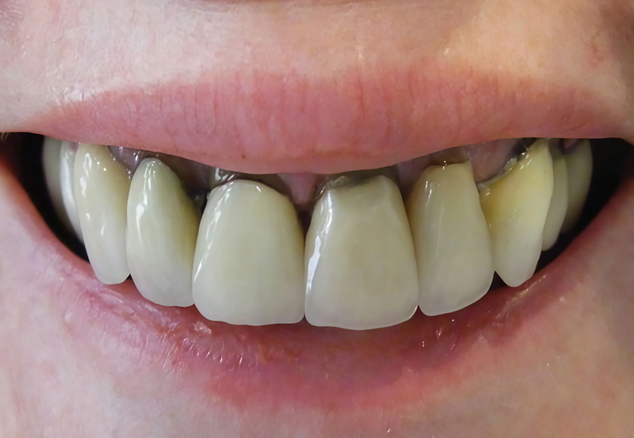 Nguyên nhân bọc răng sứ bị đen viền nướu & Cách khắc phục