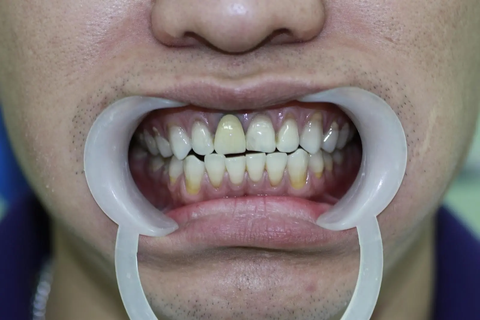 Nguyên nhân bọc răng sứ bị đen viền nướu & Cách khắc phục