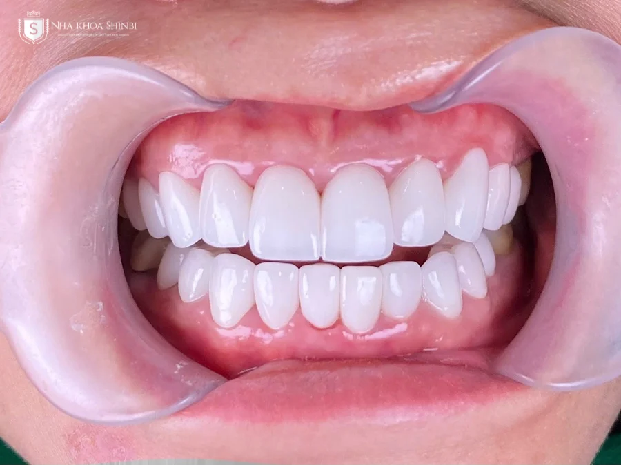 Nguyên nhân bọc răng sứ bị đen viền nướu & Cách khắc phục
