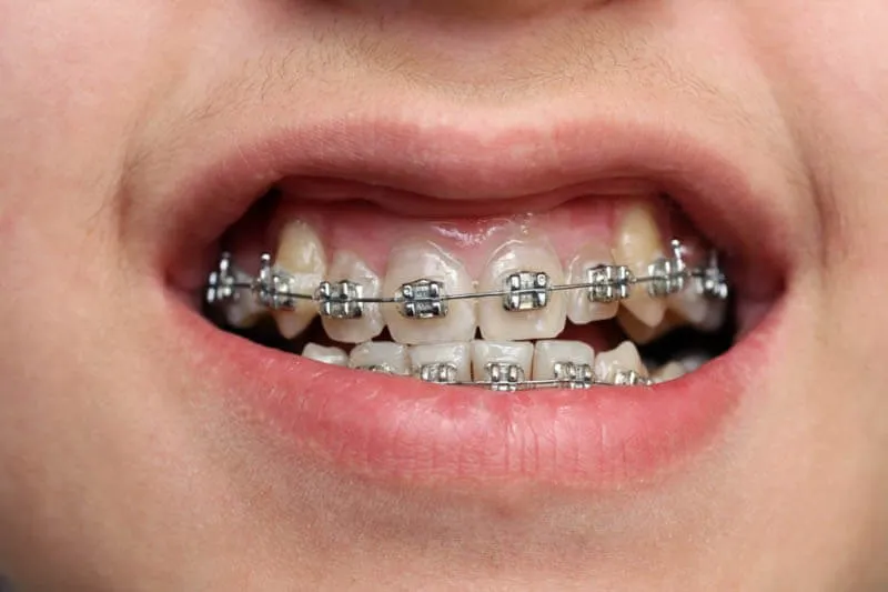 Niềng răng mắc cài kim loại: Hiệu quả tối đa, chi phí tối thiểu