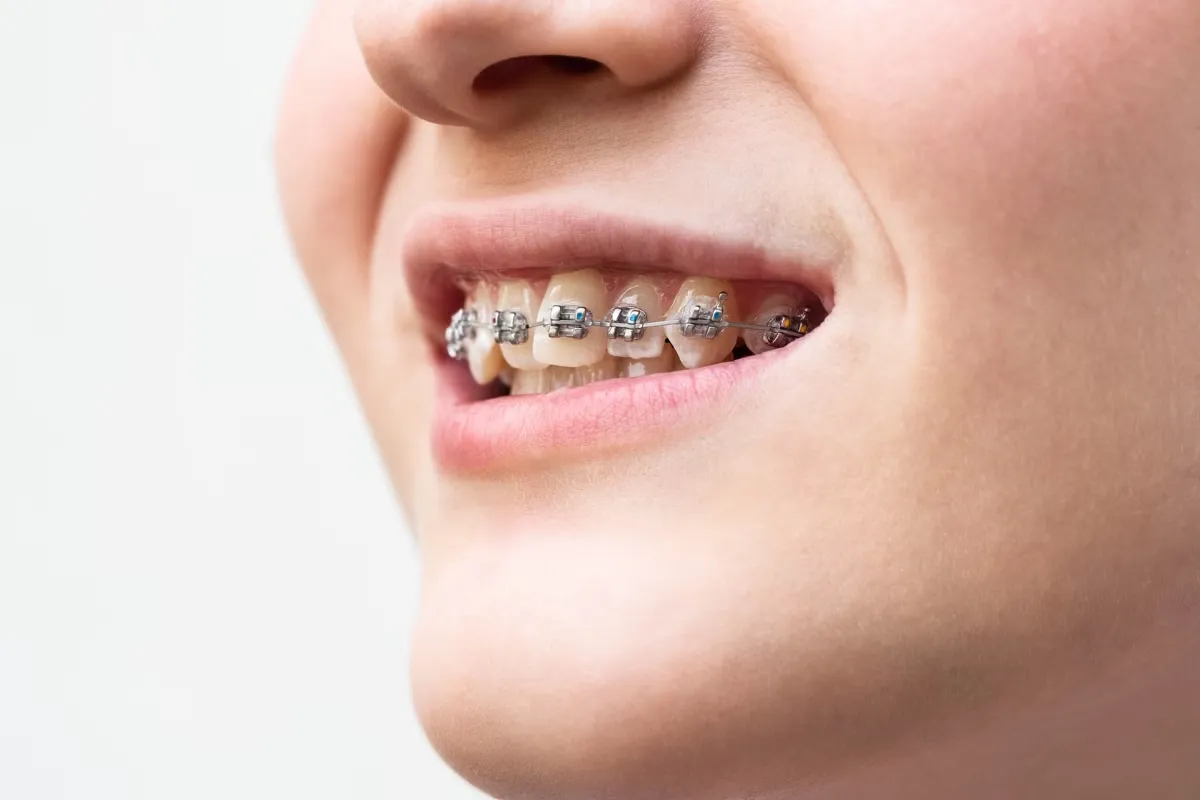 Niềng răng mắc cài kim loại: Hiệu quả tối đa, chi phí tối thiểu
