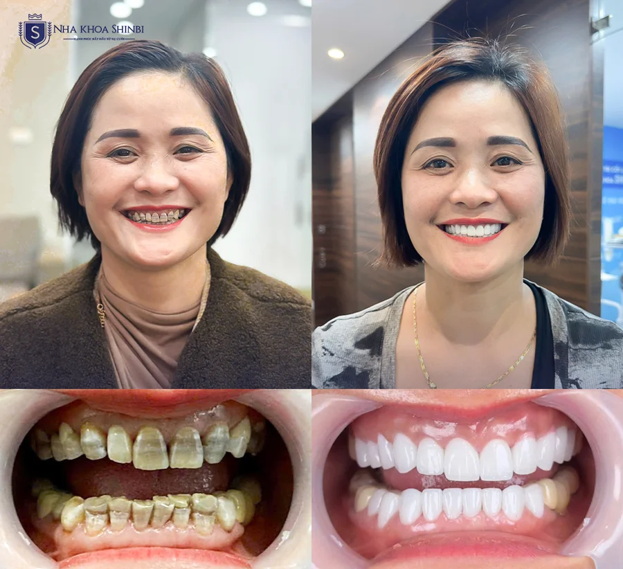 Shinbi Hải Phòng: Ưu đãi làm răng sứ trả góp 0% – Chỉ cần CCCD gắn chíp