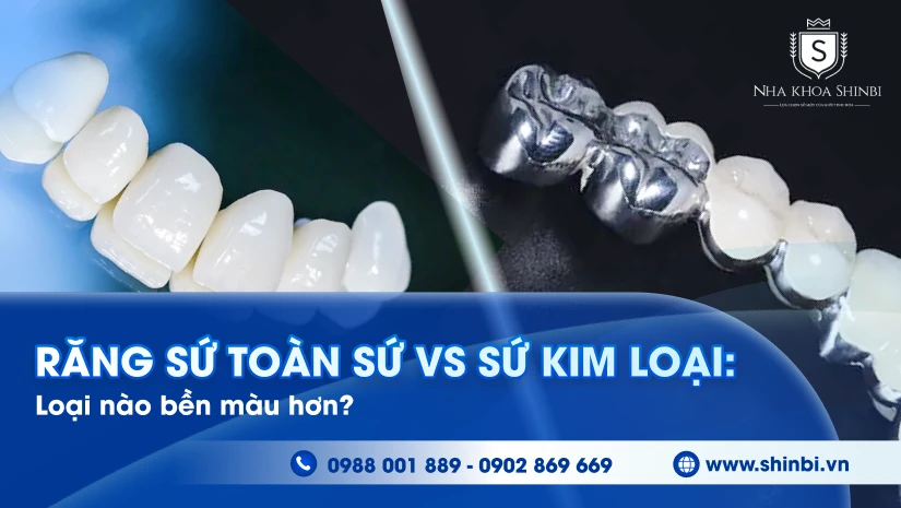 Răng sứ toàn sứ vs sứ kim loại: loại nào bền màu hơn?