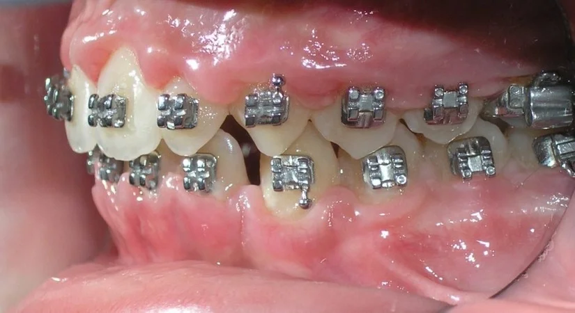 Cách vệ sinh răng khi niềng: tránh sâu răng & bung mắc cài