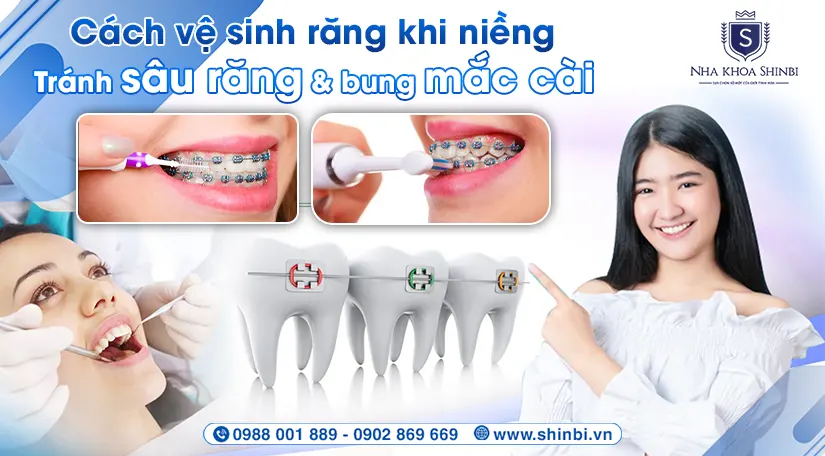 Cách vệ sinh răng khi niềng: tránh sâu răng & bung mắc cài