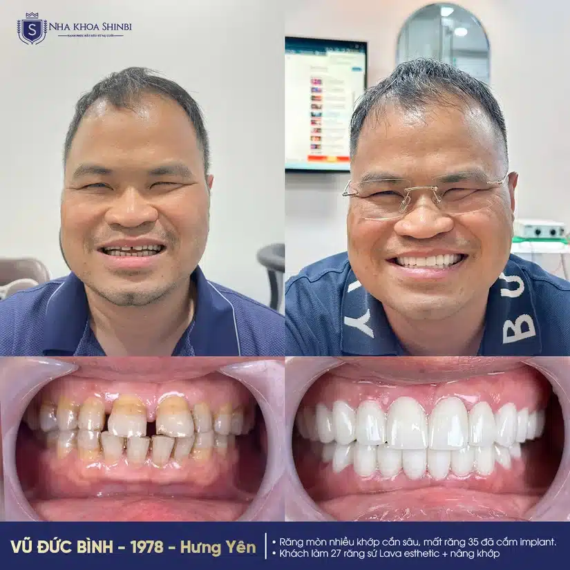 Chính sách bảo hành và quyền lợi khách hàng khi làm răng trả chậm