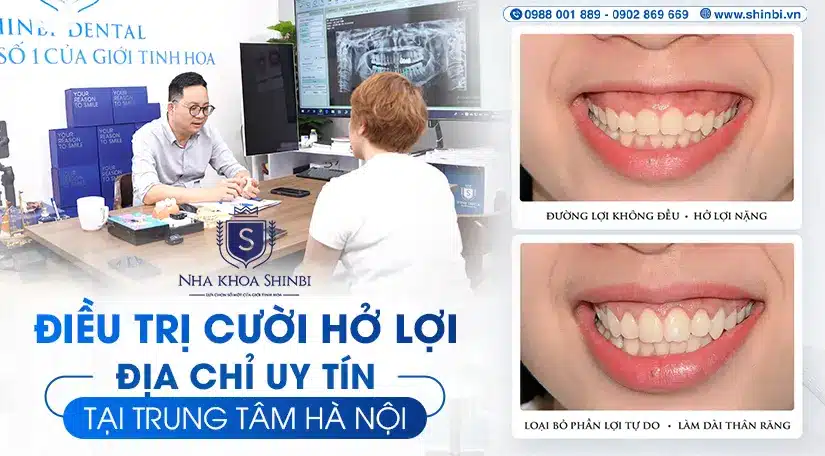 Điều trị cười hở lợi gần đây uy tín tại trung tâm Hà Nội