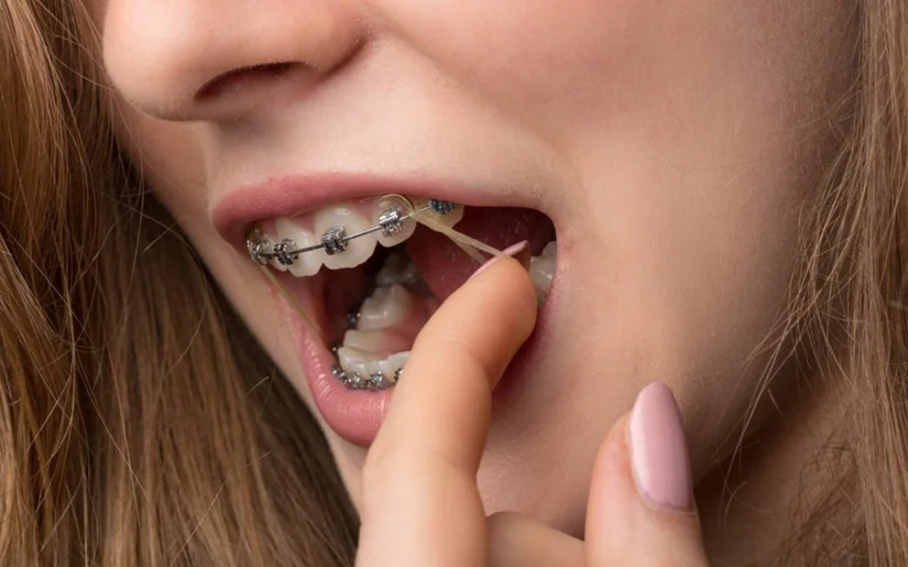 Gắn chun liên hàm: tác dụng, thời gian đeo & lưu ý quan trọng