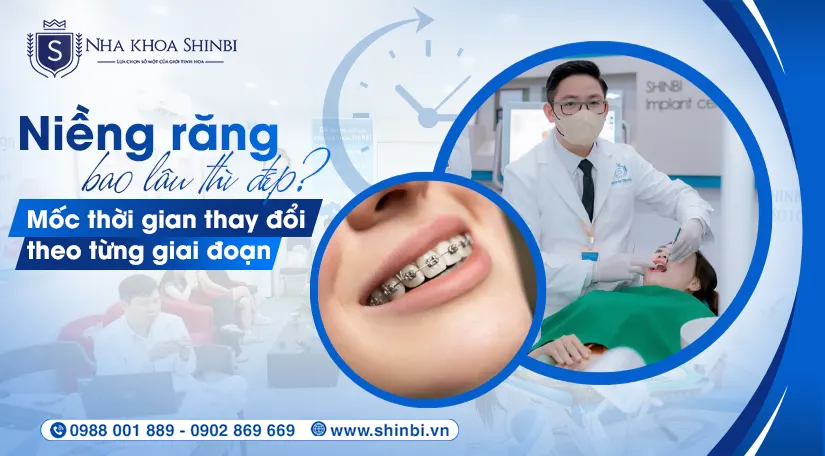 Niềng răng bao lâu thì đẹp? Mốc thời gian thay đổi theo từng giai đoạn