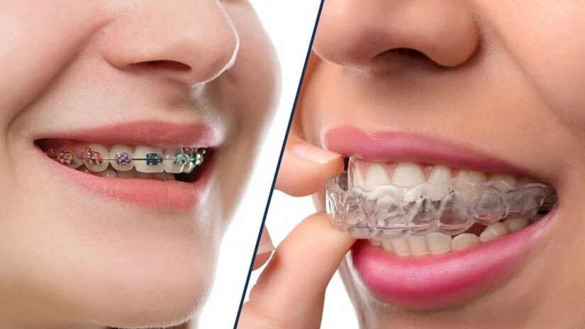 Niềng răng bao lâu thì đẹp? Mốc thời gian thay đổi theo từng giai đoạn