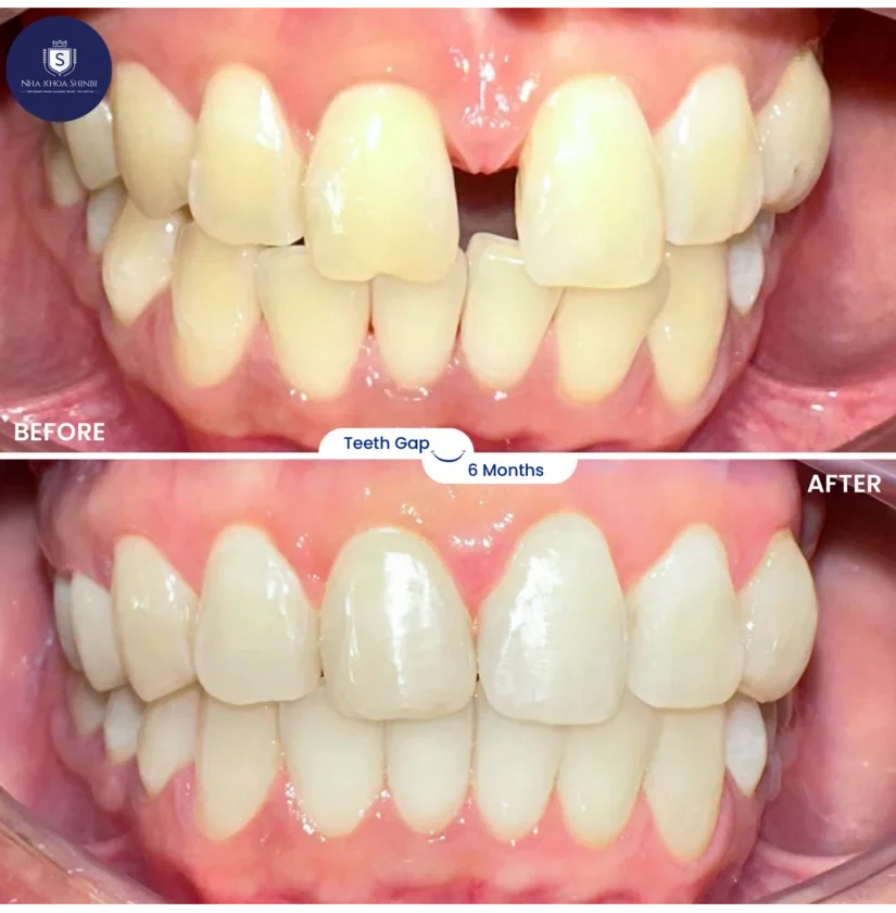 Niềng răng bao lâu thì đẹp? Mốc thời gian thay đổi theo từng giai đoạn