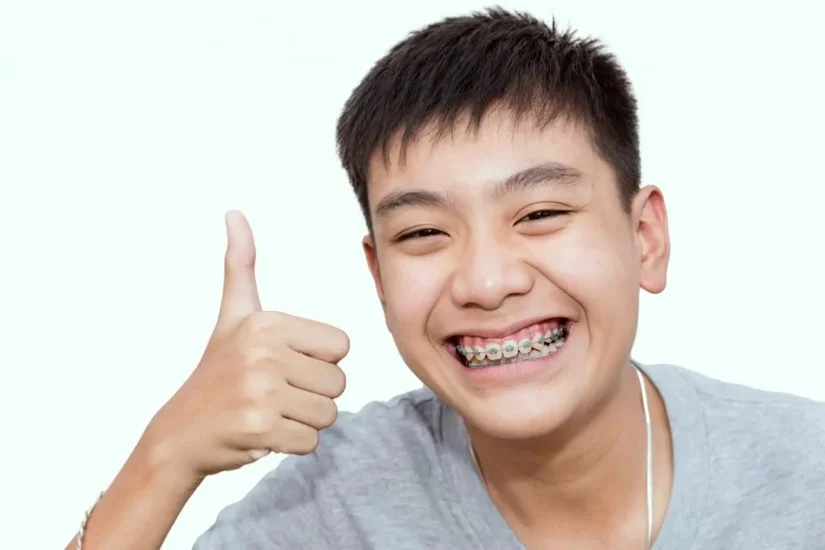 Niềng răng bao nhiêu tuổi tốt nhất? Mốc thời gian cho trẻ em & người lớn