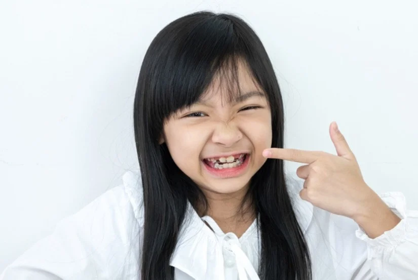 Niềng răng bao nhiêu tuổi tốt nhất? Mốc thời gian cho trẻ em & người lớn