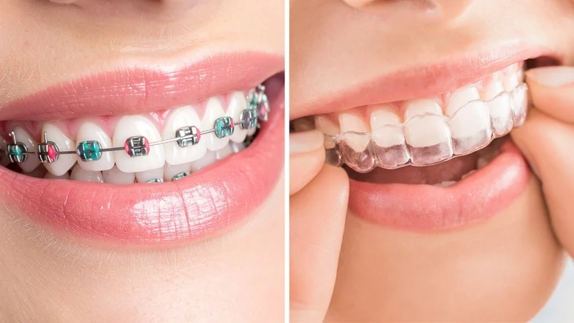 Niềng răng không mắc cài: áp dụng khi nào? Có thực sự hiệu quả?