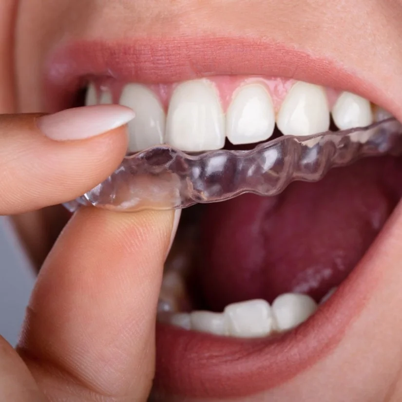 Niềng răng không mắc cài: áp dụng khi nào? Có thực sự hiệu quả?
