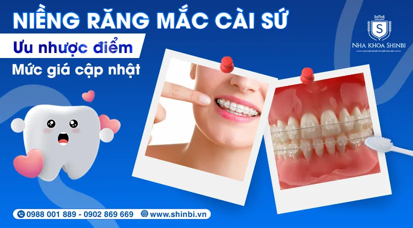 Niềng răng mắc cài sứ: ưu nhược điểm & mức giá cập nhật