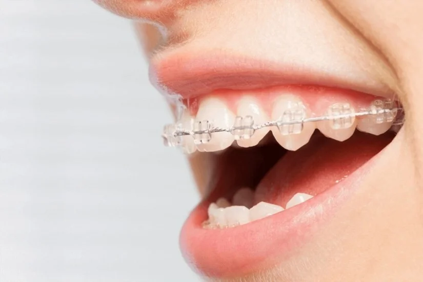 Niềng răng mắc cài tự buộc khác gì mắc cài thường?