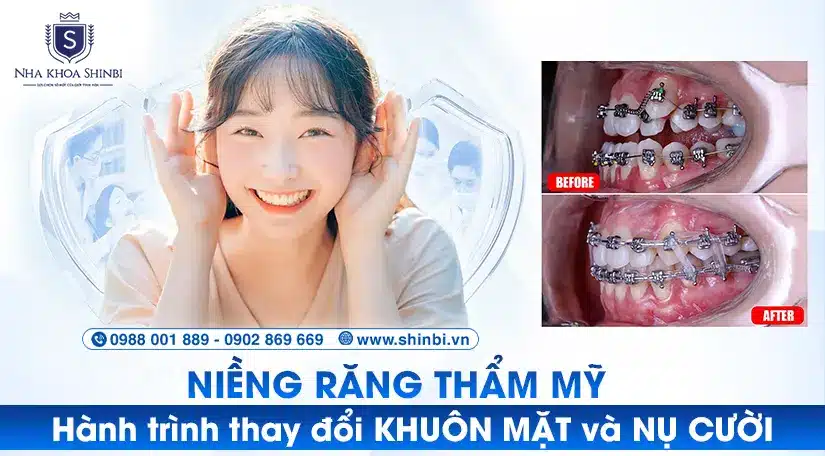 Niềng răng thẩm mỹ: Hành trình thay đổi khuôn mặt và nụ cười